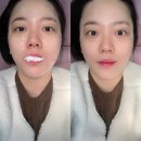 강남역10번출구피부관리 / 플라소닉 플라즈마+더블로골드 리프팅 후기 [코넬피부비뇨기과]