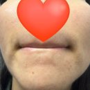 수란트란 크림 2주 후기-좁쌀형 주사피부염 rosacea-내돈내산 광고ㄴ⭐️