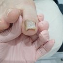 수암 | 울산문제성발톱 관리 하이푸스 울산수암점 방문 후기