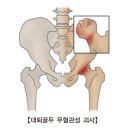 대퇴골두 무혈관성 괴사(AVN of hip(femoral head) 근 골격질환이란? 이미지