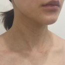 광화문피부과 쇄골주름 목주름 필러 통증,유지력 테라스의원 후기