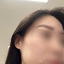 원함한의원 | 여드름 흉터 새살침 휴본한의원 금액 상담 후기