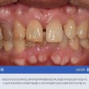 원탑 치과기공소 | 앞니 벌어짐을 크라운으로 교정한 치료 사례