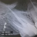 잇몸뼈 녹음 발치? NO! 치아 뿌리 염증 컸던 치아 재신경치료로 살린 후기 [공덕 재신경치료 치과]