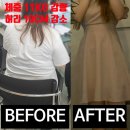 신선한의원 | 삼성한의원 마운자로 효과 3개월 -11KG 후기