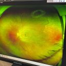 배곧서울안과의원 | 300만원짜리 유료눈에 구멍이라고?! 이거 구라죠..? #비문증 #망막열공 #배곧서울안과의원