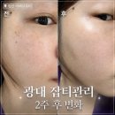 야리2길 | 양산잡티제거 아베르뷰티 왼쪽 광대 기미 잡티 관리 2주 후기