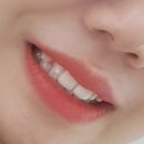 스마일라인치과교정과치과의원 | 신사역 치과 무삭제 라미네이트 후기 (1) - 상담ㅣ레브네이트 비용