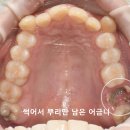 에스(S)치과기공소 | 교정 비용과 기간은 얼마나 걸릴까? 교정치과에서 알려드리는 에스라인 철사교정으로 사랑니 살리는 후기