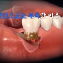 치주염 스케일링만으로는 부족한 이유 이미지