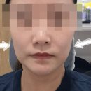 광덕고 앞 버스정류장옆 | [강남역 피부과] 울퉁불퉁 땅콩형 얼굴 탈출! 고우리 옆볼 패임 시술 리얼 후기
