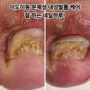 제주청년홈케어 | 이도이동 문제성 내성발톱 케어 잘 하는 네일하루!