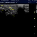 Rupture within Anterior Talus Fibula Ligment , Deltoid ligment , Calcanius Fibula Ligament 이미지