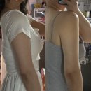 리라 | 삼성역피부과 팔뚝지방분해주사 리라주사 후기 효과