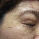 다나을한의원 | [평택 용이동]평택안성 편평사마귀 얼굴부위 가성비 제거 한의원 내돈내산 찐후기