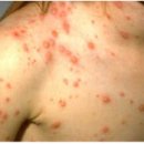 수두[chicken pox] 이미지