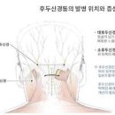 후두신경통 및 (뒷머리 통증, 뒷통수 통증) 이미지