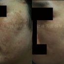 레이저토닝 부작용: 심한 레이저토닝 부작용의 치료. 연세지움피부과. 이미지