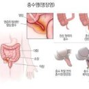 맹장염 초기 증상 맹장 터지는 이유 급성 만성 차이 여자맹장위치 이미지