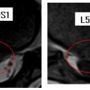 랄라라 님의 허리디스크 L5-S1의 MRI 사진 판독입니다. 이미지