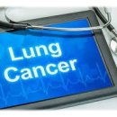 폐암의 진단과 치료 그리고 차선책은 무엇인가? 이미지