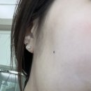 갑자기 뽐뿌와서 점 뺀 후기와 최근 피부과 고찰