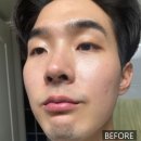 루카스병원 | 부천피부과 | 남자 레이저 수염제모 2회차 받고 온 수염제모후기!