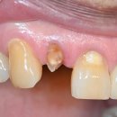 디자인탑치과기공소 | 광교 임플란트 치료 과정. 발치 즉시, 무절개 임플란트. 광교탑치과, 수원 광교 치과