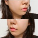 명동피부과 온다리프팅 효과 내돈내산 후기
