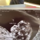 한얼한의원 | [임신11주차] 1차 기형아검사 목 투명대 후기