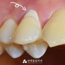명동아름다운치과의원 | 양치할 때 시린이 치료 레진 보험재료 동대문치과