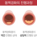 혈관 노화로 인한 대표적인 질환 죽상동맥경화증! 이미지