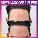 [20대 남성 넓은 이마 4000모 모발이식] 비절개 히든컷 2주, 3개월, 9개월, 1년 후기 (모엠의원/M자탈모/전지훈원장) 이미지