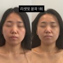 로아핏 | 안성 피부관리ㅣ50대 로아님 실제 후기, 홍조에서 윤곽 리프팅까지