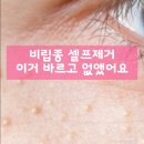 삼일A | 진주알 같은 비립종, 레티놀A 삼일 만에 없앤 후기