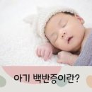 백반증 원인 백반증 아기 백반증 유전 이미지