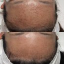 (주)에프알메디칼랩 | 청소년 여드름 관리, 피부과 vs 피부 관리실 어디가 맞을까?