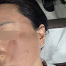 라비앙의원 | 창원 프락셀 + 아큐토닝 + 라비앙 레이저 후기 일주일 변화 (내돈내산)