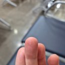 지에스25 분당제생병원점 | 분당제생병원 이물질 제거 수술후기