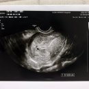 자연차 | 임신 그리고 8주차 자연유산 후기