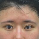 슈어스성형외과의원 네이버블로그