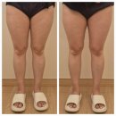 이수정피부관리실 | 용인기흥에스테틱 / 메디스파연, 다이어트 림프순환 하체 부종관리 후기