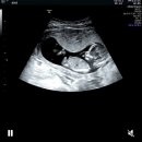 GS25 산본타운점 | 심음기/남대문 신생아옷 쇼핑/ 안산 베이비하우스/산본제일 16주 2차 기형아 검사/ 성별공개 - 반전 없음)