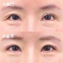 올로성형외과의원 | 쌍수라인낮추기전후, 간단한 눈재수술이 아닙니다