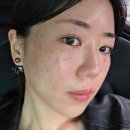 청담동피부과추천 셀트라콜, PRP 주사 후기 (+엠보싱, 주사자국)