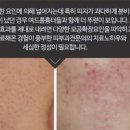 모공확장증 원인 모공확장증 개선 모공확장 예방법 이미지