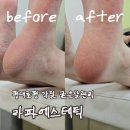 라파백세건강프라자 | [리뷰] 평내호평각질굳은살애기발관리 라파에스테틱 후기