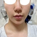 블리비의원 | [성남 모란역 피부과] 블리비의원 : 슈링크 쥬베룩 볼륨 후기