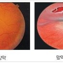 아토피와 열공성 망막박리 이미지