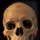 부어치킨 내수점 | 성형수술후기, 얼굴윤곽수술(광대축소 수술), '제3탄' - 수술 후 결과 및 회복 과정(긴글 주의)